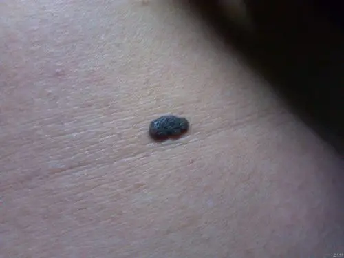 朋友担心的瘤状物色素痣请帮鉴别