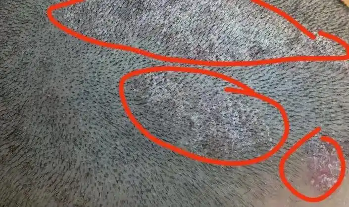 头皮屑很严重洗完头干了之后头皮上就是一层摸上去像疙瘩总忍不住去抠