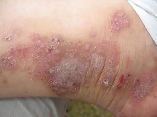 男性疥疮皮肤起疹图片