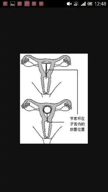 【知识贴】上环,结扎,皮下埋植的原理和分别!