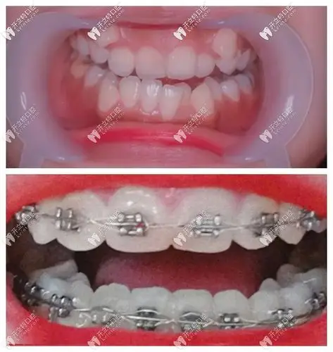 虎牙外凸很难矫正?听说她戴damon自锁牙套5个月虎牙被拉正了