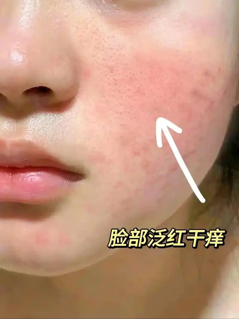 脸部泛红像这姐妹真的要小心了.