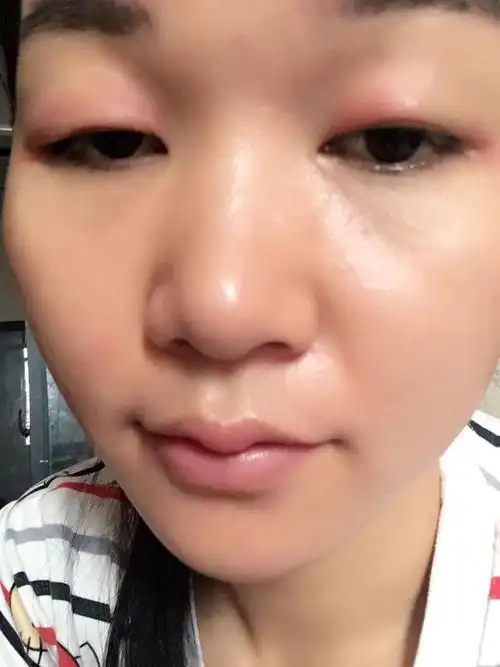 眼睛肿得难受,怎么办才好