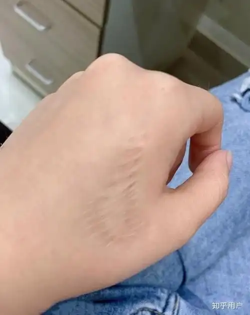 右手手背有很大疤痕,很自卑,找工作特别难,怎么办? - 知乎