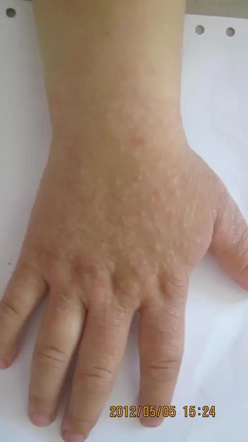 分享病例----------摩擦性苔癣样疹 - 皮肤及性传播疾病讨论版 - 爱爱