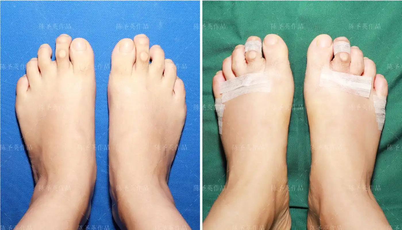 小脚骨会导致足部外观缺陷,局部红肿发炎,甚至破溃,感染.