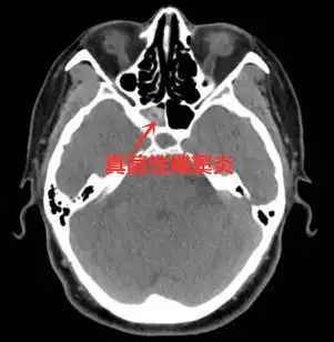 头痛有可能是真菌性蝶窦炎_鼻窦炎_鼻窦炎症状表现 - 好大夫在线