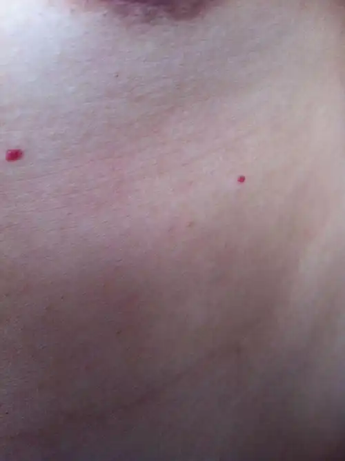 亲身上小红点是什么.谢谢