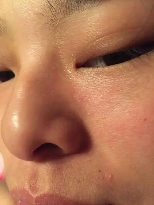 有什么好的方法解救?已经这样三天了,我个人觉得不是皮肤干燥.