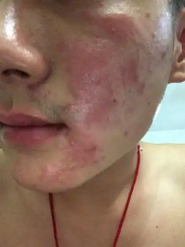 皮肤过敏 瘙痒 硬块状.还皮肤干燥