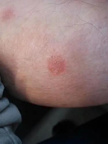 关于皮肤病问题.