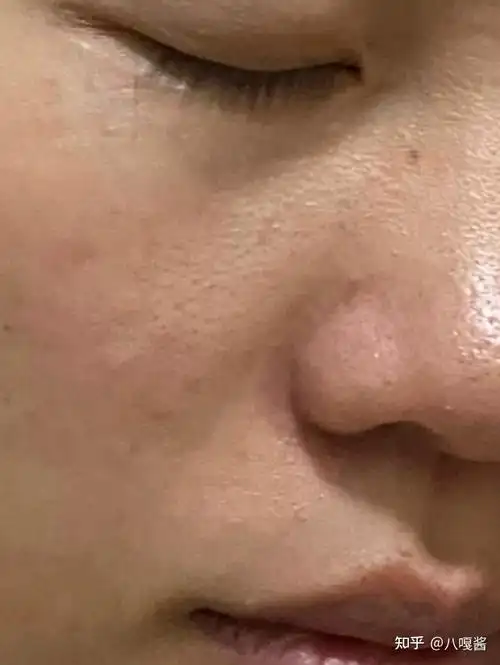 脸上看着又黄又糙怎么去角质才能不伤害皮肤有什么好用的脸部去角质