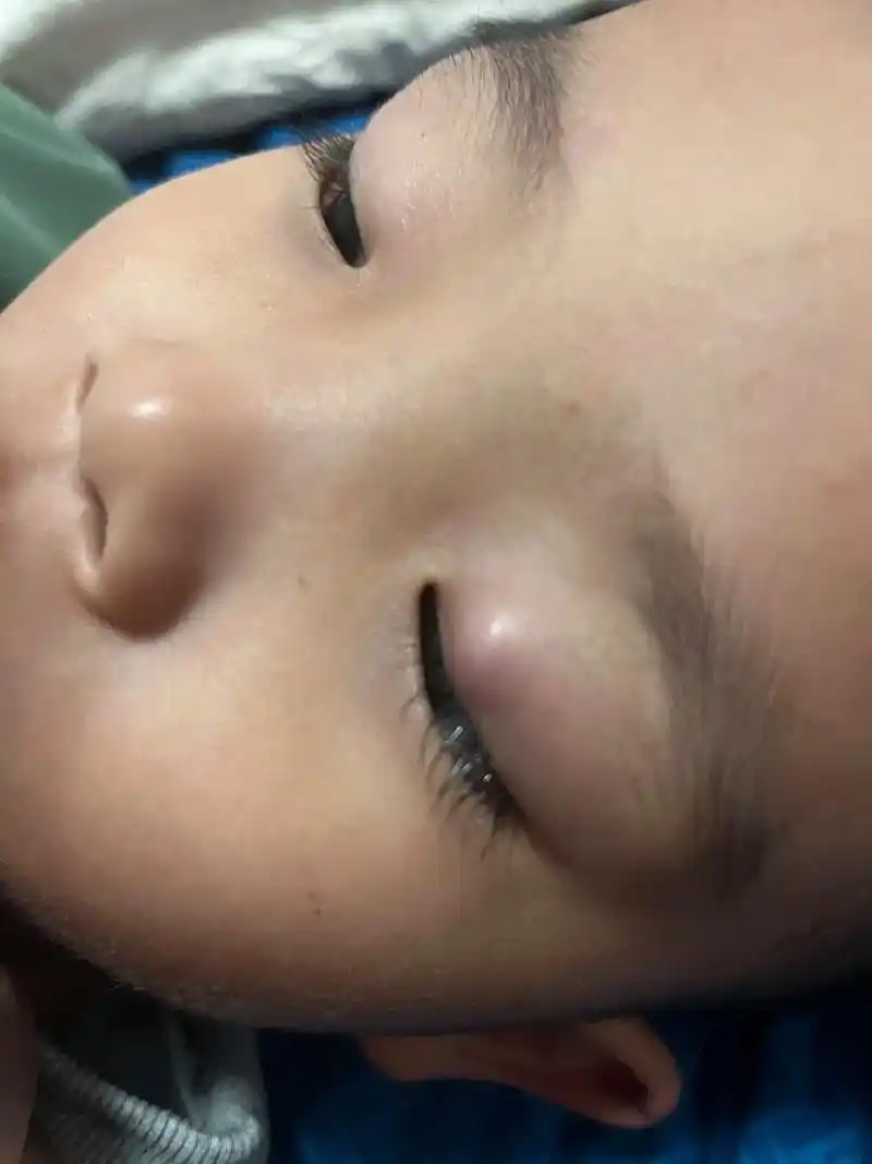 宝贝的睑板腺囊肿(霞粒肿)不做手术治好啦