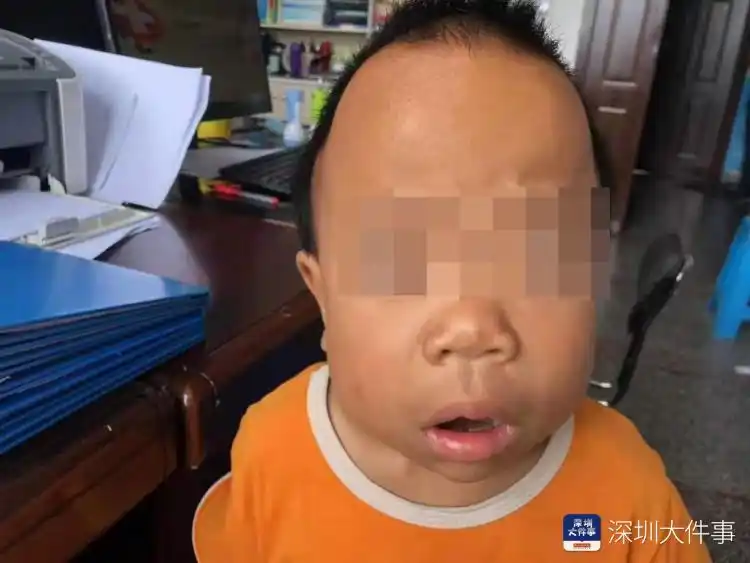 5kg,身高刚过1米,鸡胸,骨骼畸形,口唇外翻,头颅增大,按照"佝偻病"医治