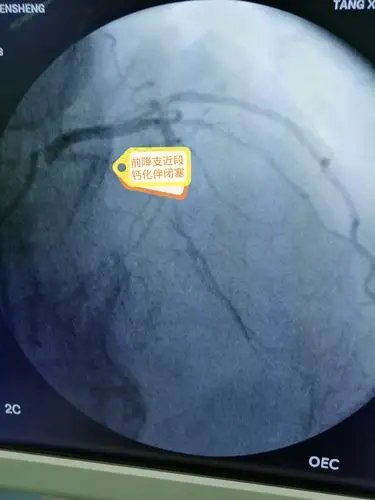 患者左侧冠脉造影图像