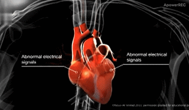 窦房结(sa)是心脏的正常起搏点,产生的电信号经传导系统传导到整个
