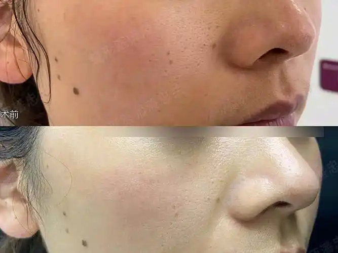 毛孔粗大黄金微针一次治疗效果对比#拯救毛孔行动
