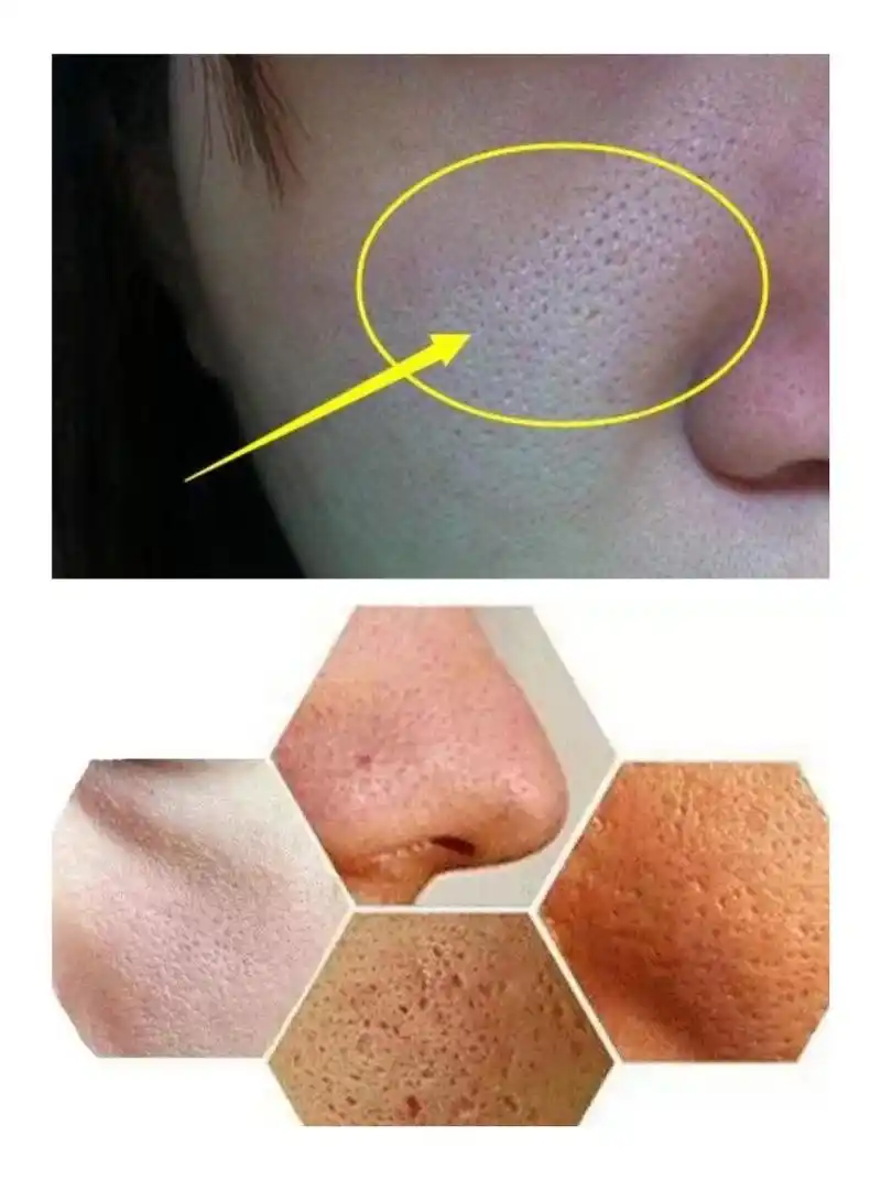 96毛孔粗大一般是因为皮肤弹性变差,毛囊口堵塞,毛囊_圈子-新氧美容