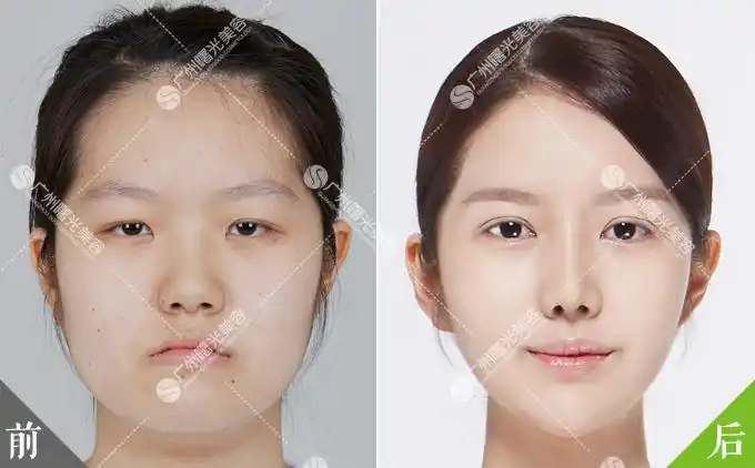 张萌萌面部吸脂前后对比
