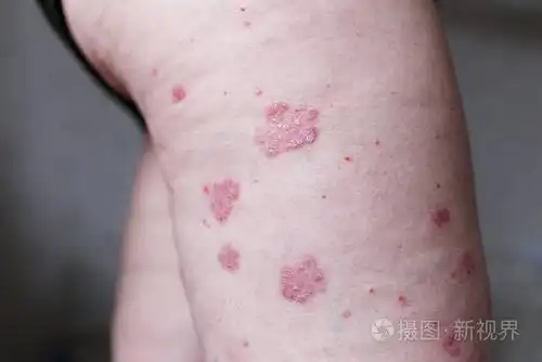 过敏性皮疹皮炎湿疹皮肤病人的腿.银屑病和湿疹皮肤有大红色斑点.