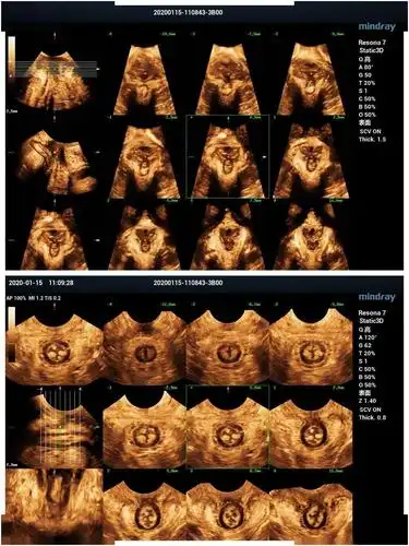 诊断结果前盆腔:膀胱脱垂,尿道旋转角增大,膀胱后角开放,膀胱移动度