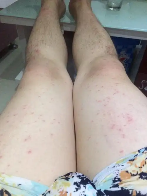 皮肤全身过敏痒难受痒