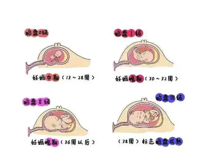 孕晚期羊水少是什么原因造成的四大诱因希望你都没中