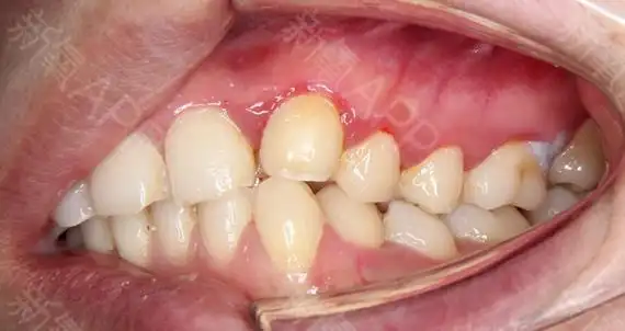 我那颗内收的虎牙之前被那边磨掉了很多,现在风一吹就感觉酸酸