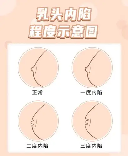 ② 二度为乳头完全凹陷于乳晕之中,但可用手挤出乳头,乳头较正常小,多