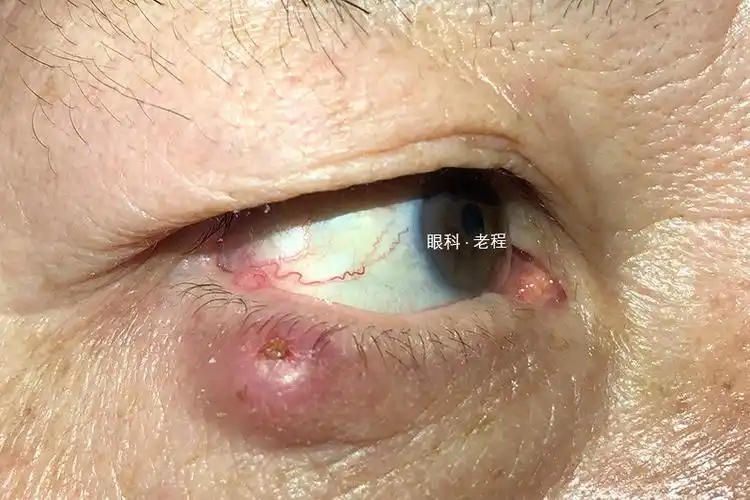 眼皮上长"肉球",是囊肿还是癌症? - 好大夫在线