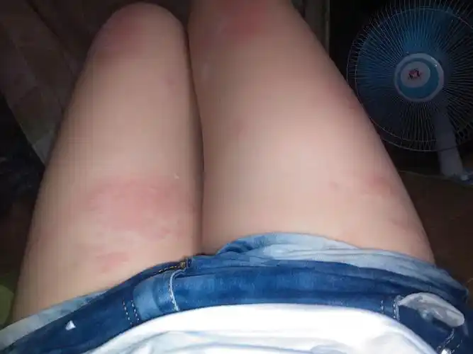 获赞数:731lv7 擅长:暂未定制 向ta提问私信ta  展开全部 过敏性湿疹