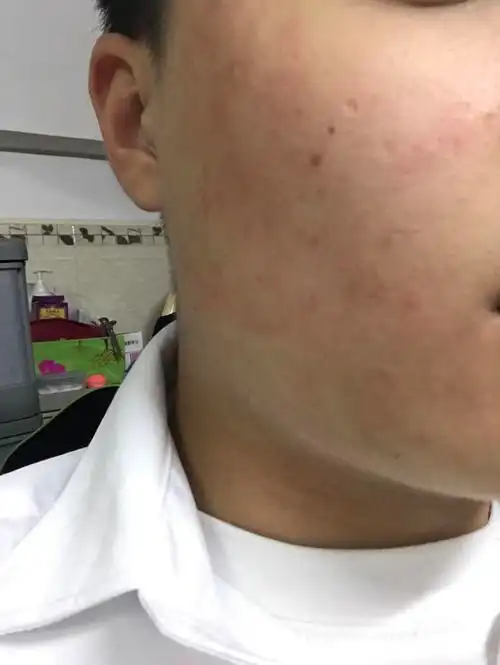 昨天用了某种洗面奶后,脸部发红,发烫,那时以为小事就没有及时洗掉烫