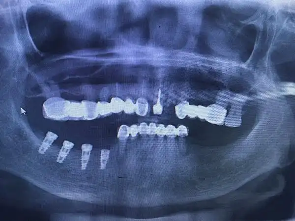 我们也完全相信,妈妈很快就会体会到现在植入的这4颗种植体