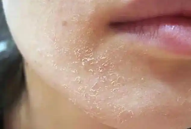 杏林微科普干性皮肤过冬要好好护理哦