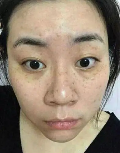 黑人女性面部长色斑图片