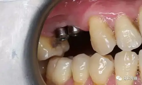 病例两颗种植牙种歪的病例补救