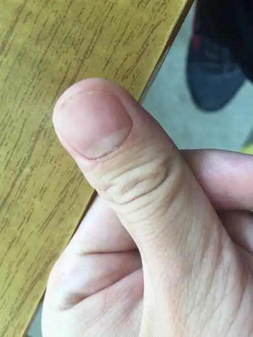 指甲根部开裂,什么问题