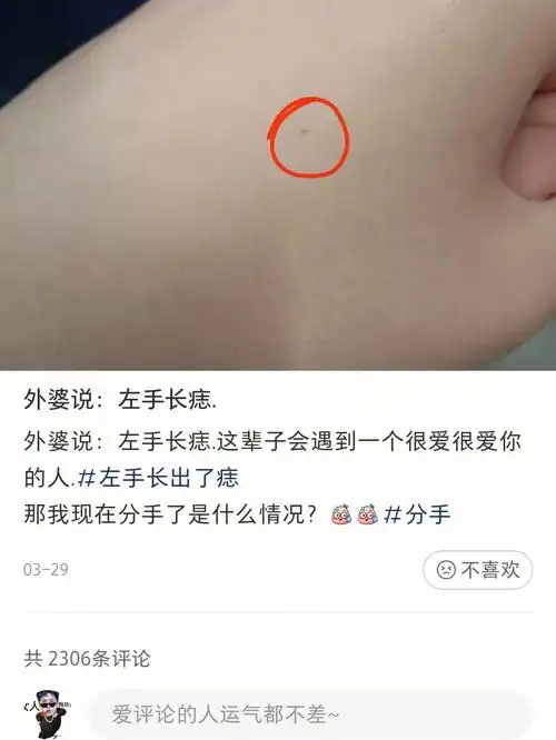 左手痣  #手腕长痣