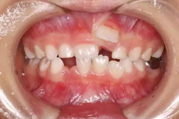 吓人的"双排牙宝宝"越来越多,跟家长的一个坏习惯有关,早点改