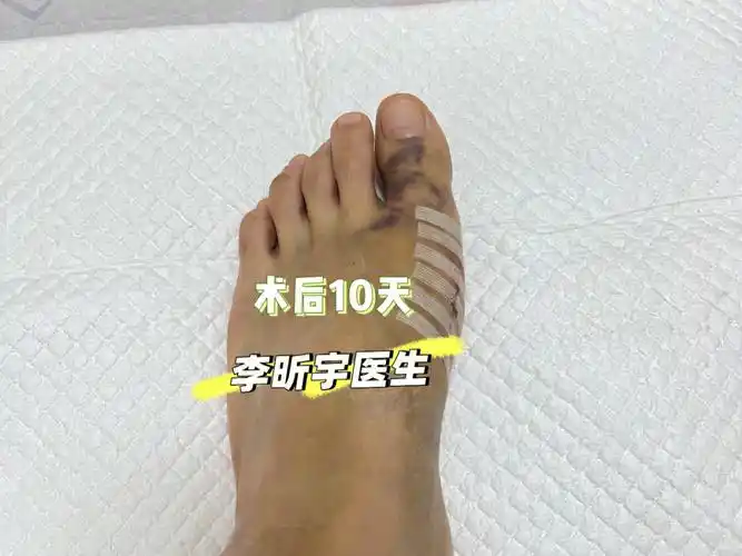 记录拇外翻术后10天