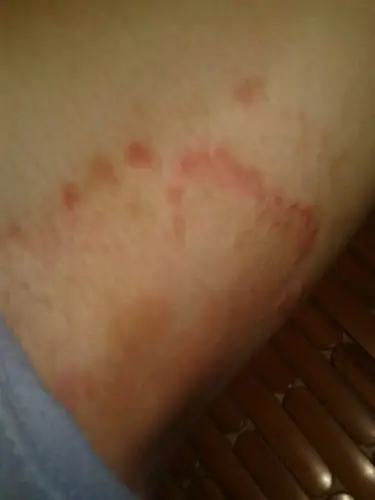 2014-06-04 于师师 医师 每年11月份我腋窝周围或大腿根处就长湿疹样