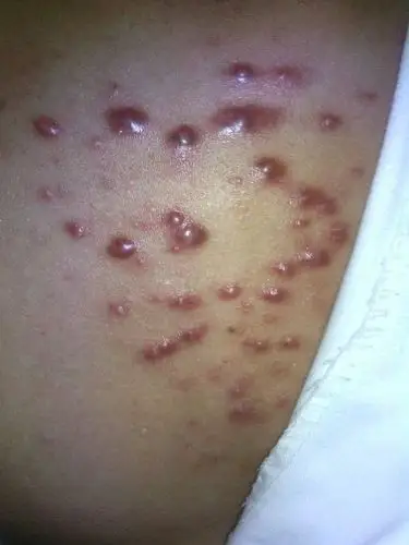 我这是马拉色菌毛囊炎吗