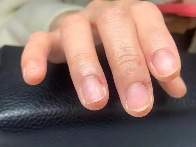 啃咬甲修手过程