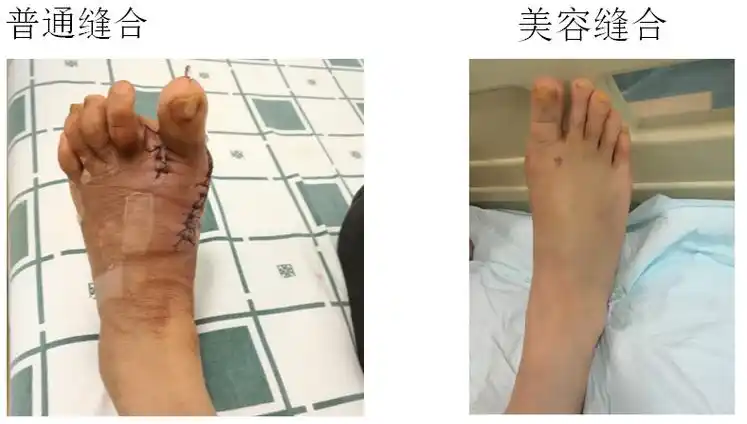 提醒广大脚趾外翻度数严重,已经符合手术指征的拇趾外翻患者,建议应该
