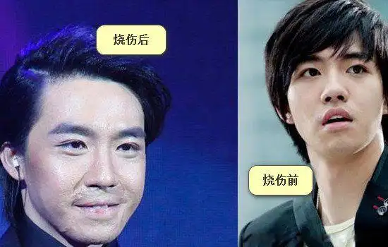 俞灏明烧伤前后对比烧伤事件视频烧伤后复出的一首歌
