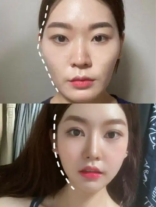 三,上海面部脂肪填充案例