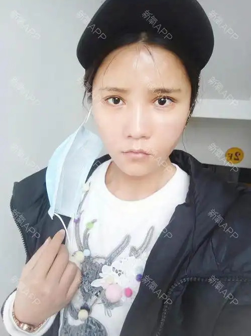 莣忧愺自体脂肪全脸填充第15天美丽日记