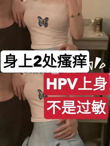 身上2处瘙痒hpv上身不是过敏
