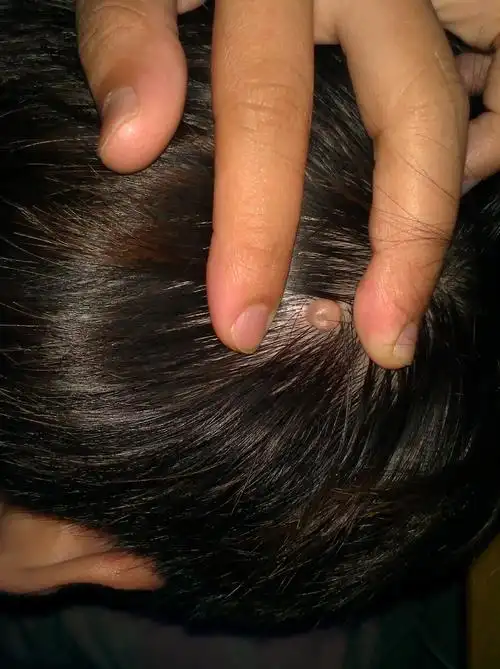 头部右后头皮长了个小肉疙瘩不疼不痒比较软不知道这个东西要不要去