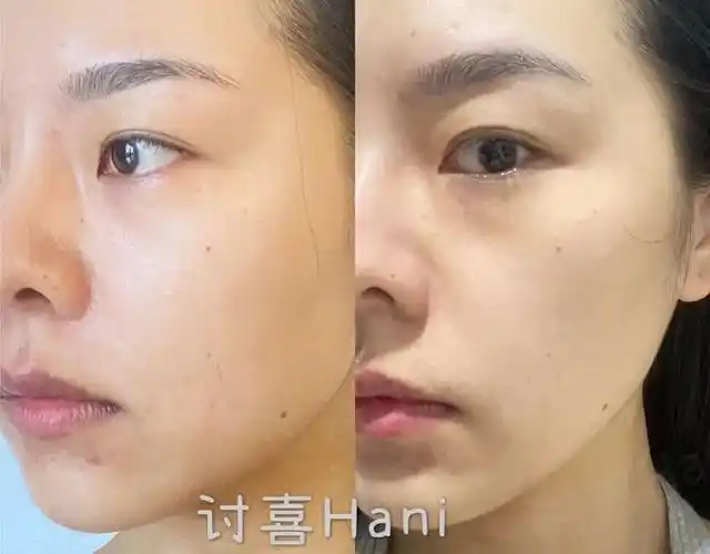 hani亲测|无论皮肤状态好坏,我都会坚持做的本命医美